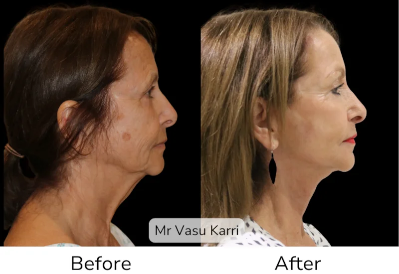 Facelift Patient 1 View 2